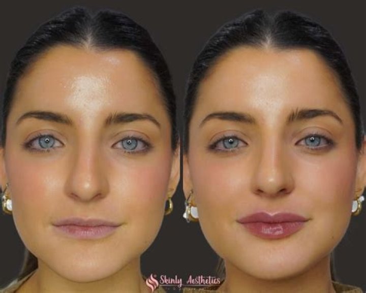The Ultimate Guide to Too Faced Lip Injection: Everything You Need to Know